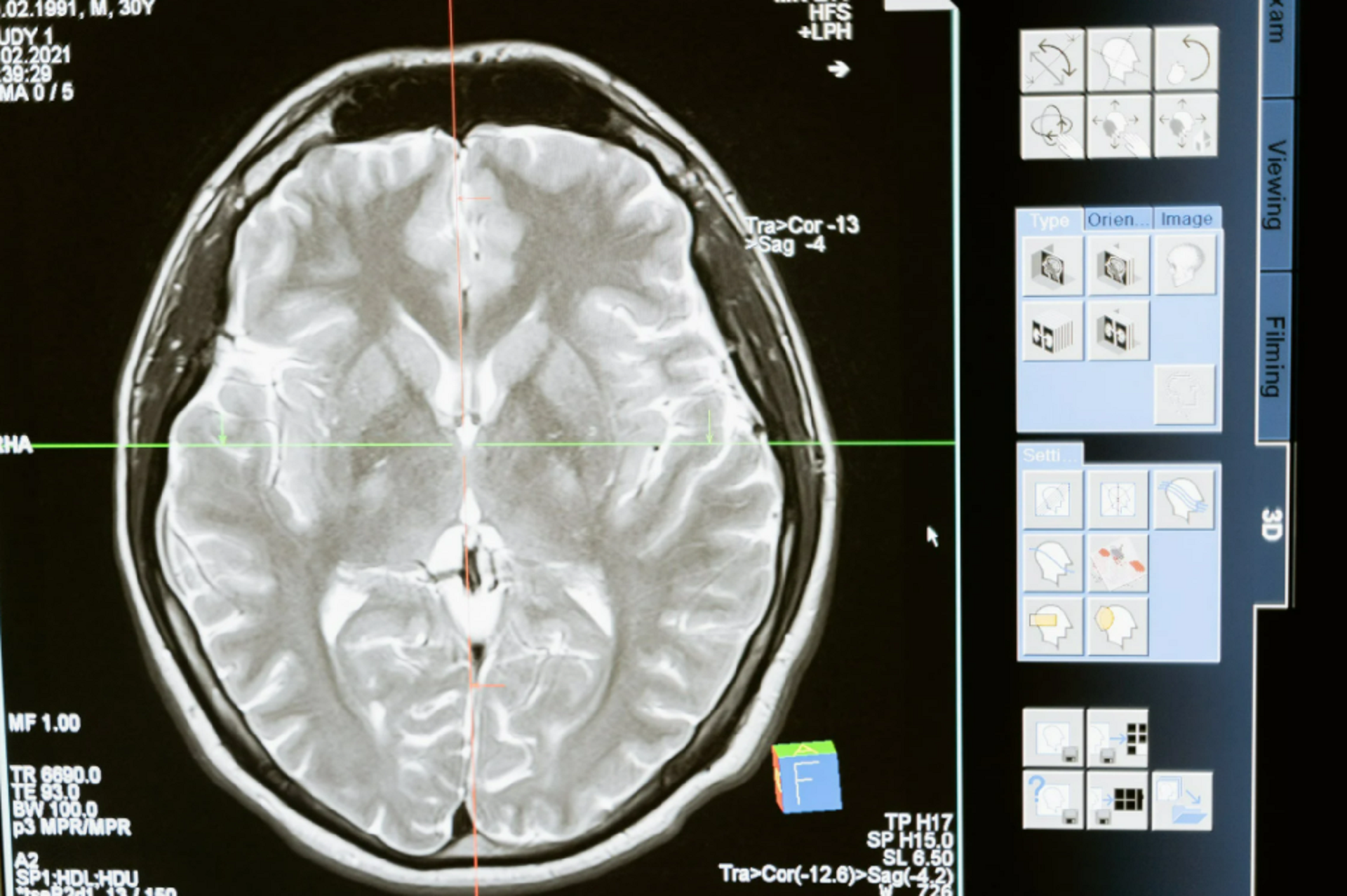 brain activity of stroke patient