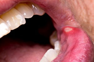 Pesky Canker Sores Be Gone!