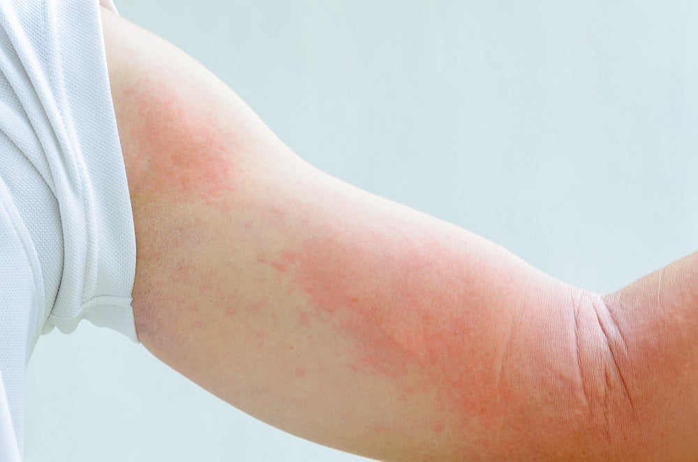 Hives And Their Causes, Symptoms, Treatments And Prevention