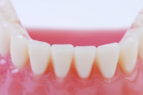 dental veneers