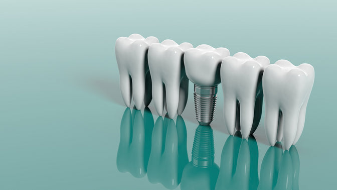 dental implants