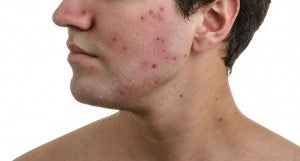 The Link Between Severe Acne Treatment And Ineffective Antibiotics