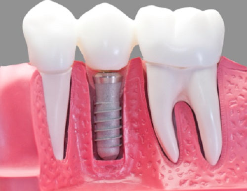 Facts About Dental Implants, Procedures And Aftercare