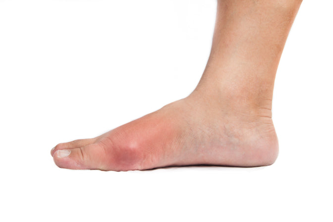 Risk Factors For Gout