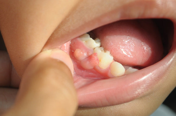 How Does A Gum Boil Develop?
