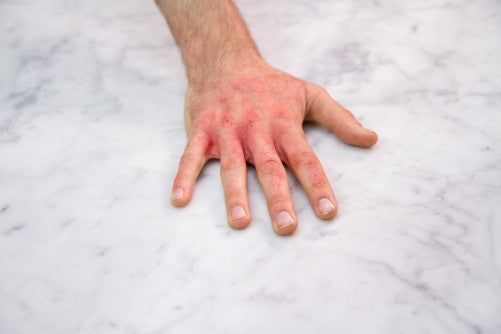 How To Prevent Hand Rashes In The Winter