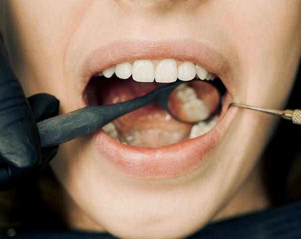 60+ Ways To Fight Oral Thrush Naturally