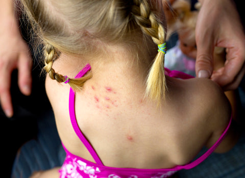 What Causes Red Blotches?
