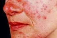 What Is Rosacea?