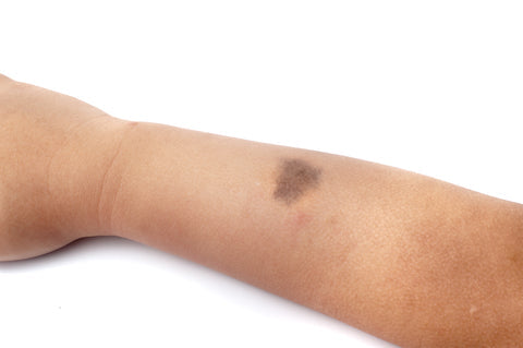 Skin Tags: The Best Natural Remedies