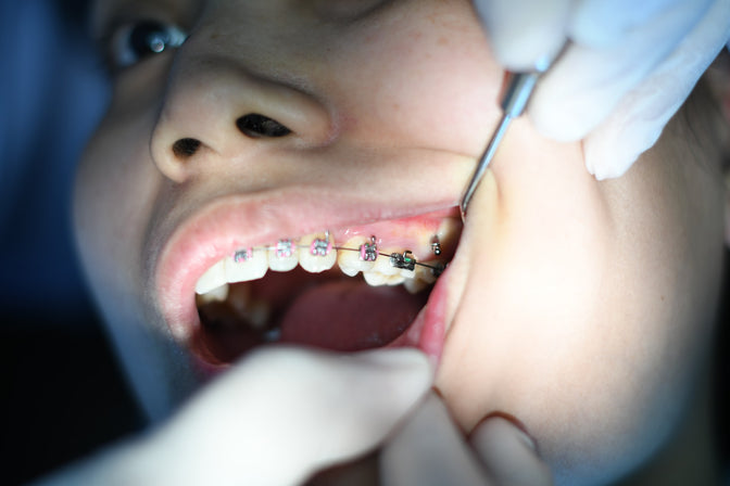 girl with braces having her wisdom teeth checked