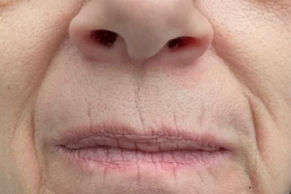 Close-up of a person's nose and mouth area with visible skin texture and lines.