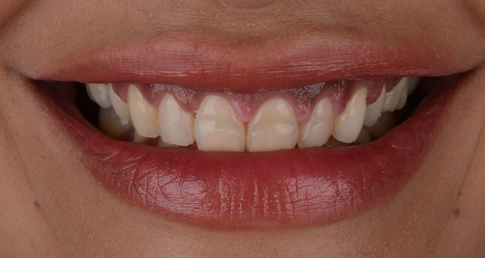 Close-up of a person's mouth with a focus on teeth.