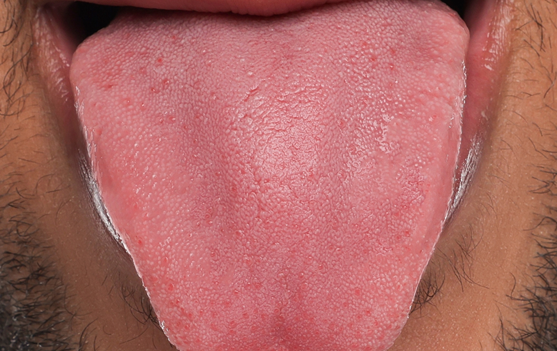 Close-up of a person's tongue with visible texture and color.