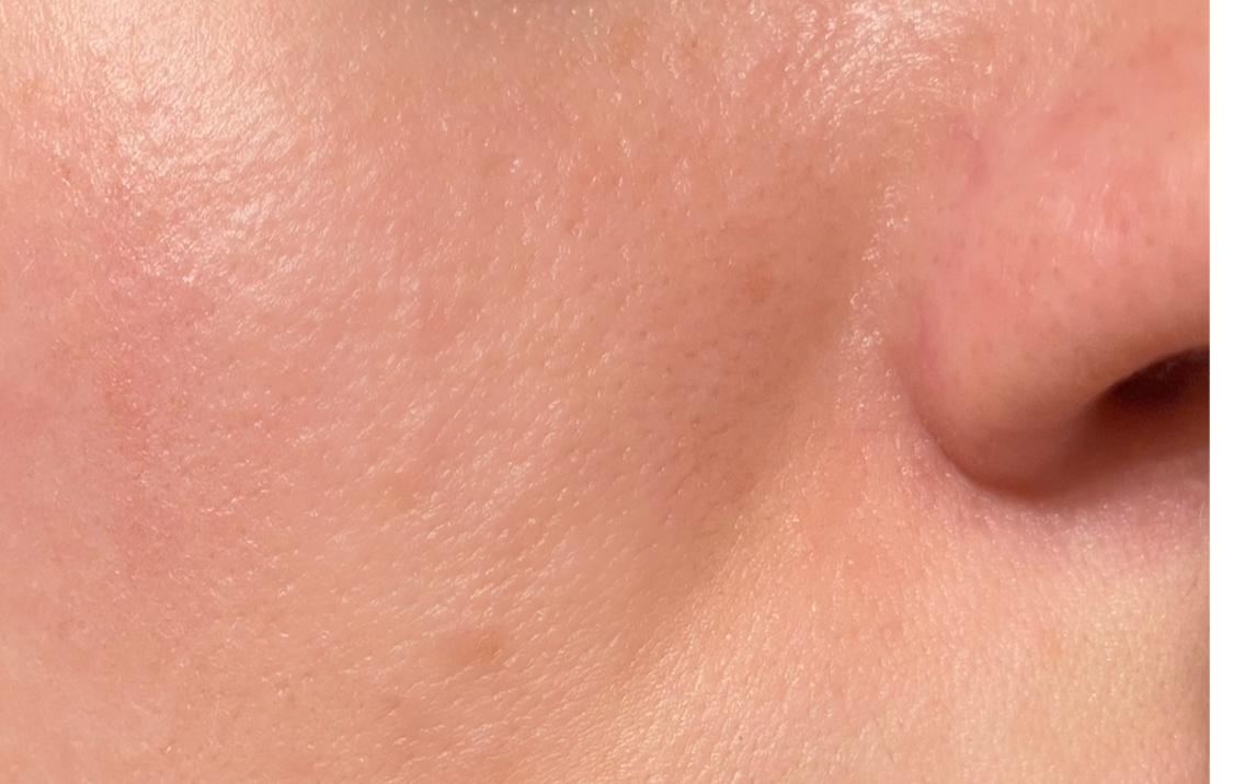 Close-up of a person's nose and cheek with visible skin texture.