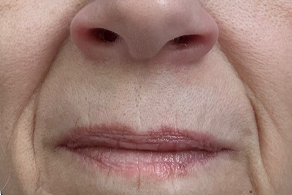 Close-up of a person's lips and nose with visible skin texture.