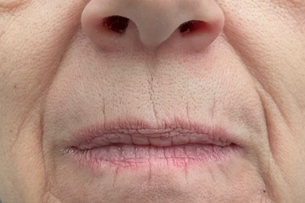 Close-up of a person's nose and mouth area with visible skin texture and lines