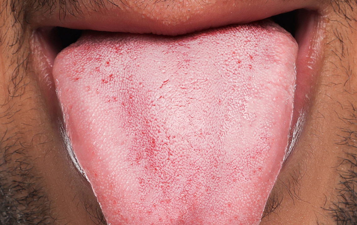 Close-up of a person's tongue with visible texture and color.