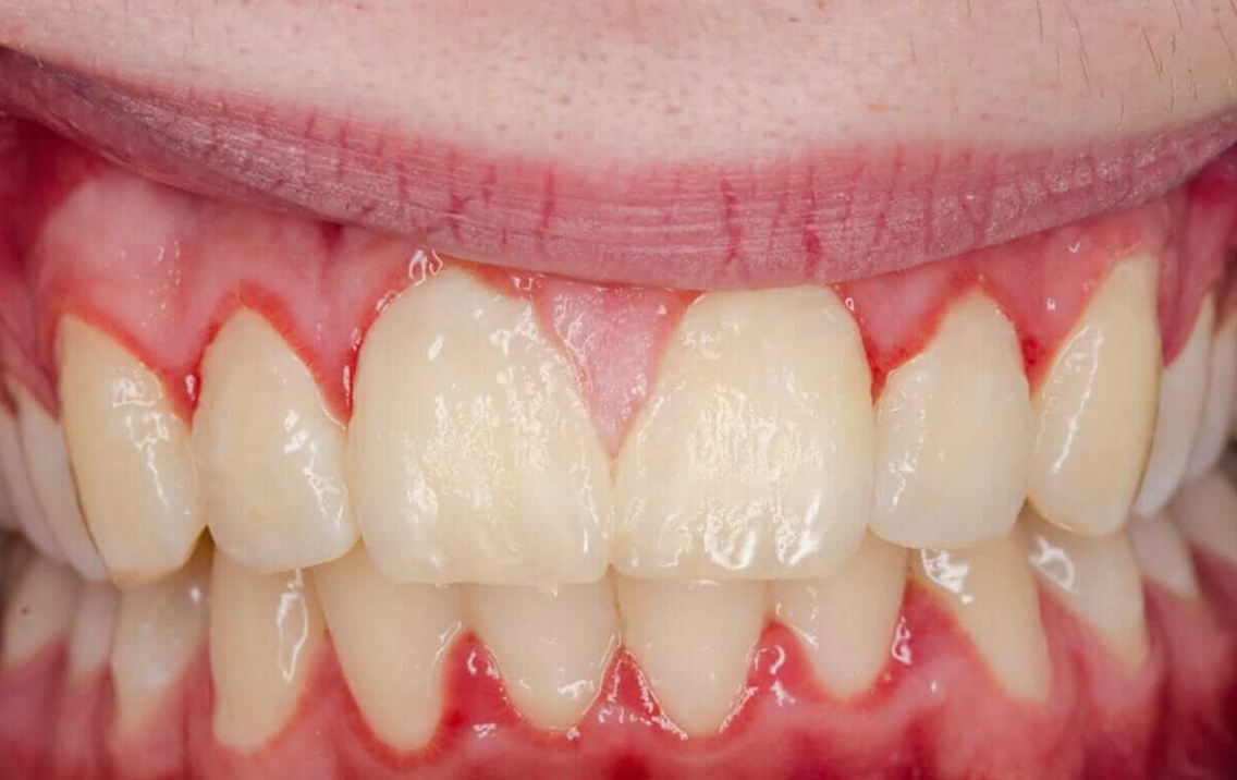 Close-up of a person's teeth with a focus on the gum line.