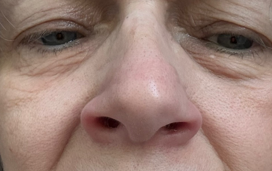 Close-up of a person's nose with visible skin texture and pores.