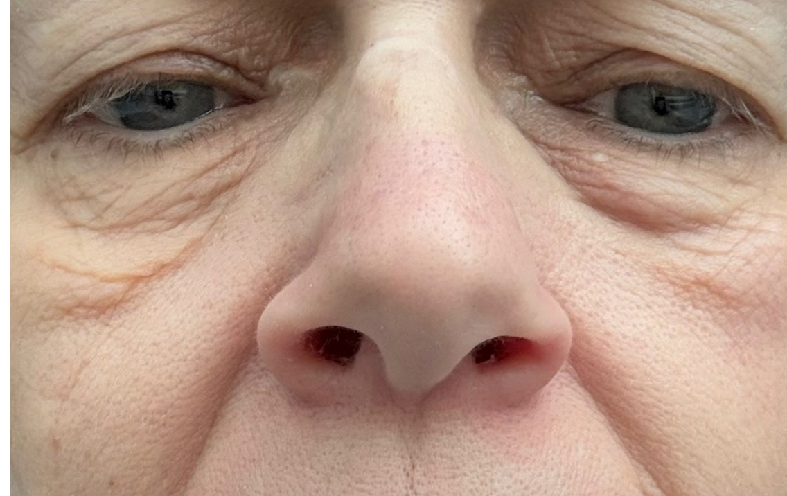Close-up of a person's nose with a focus on the nostrils.