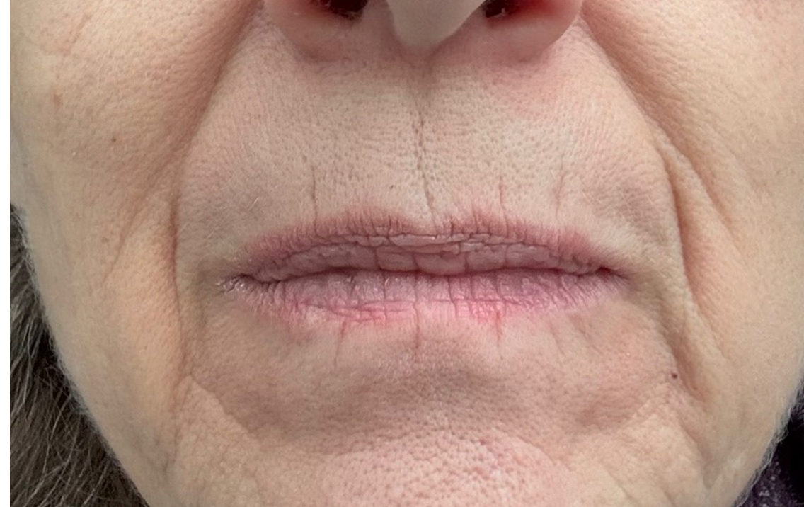 Close-up of an elderly woman's lips with visible wrinkles.