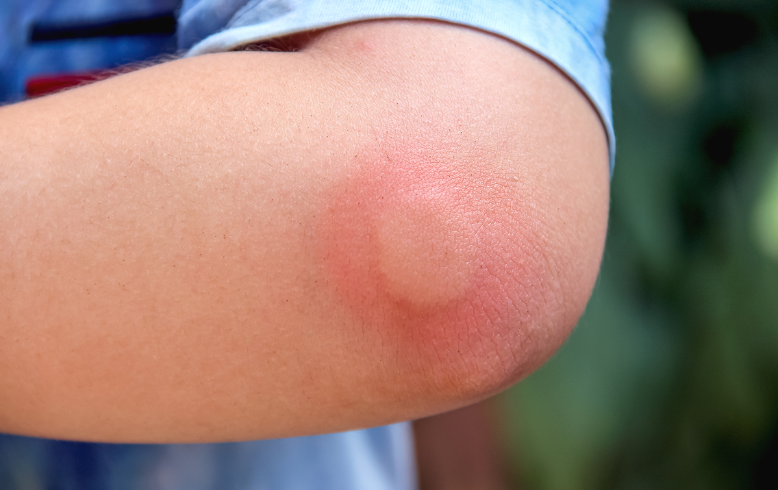 Red inflamed knee with a blurred green background