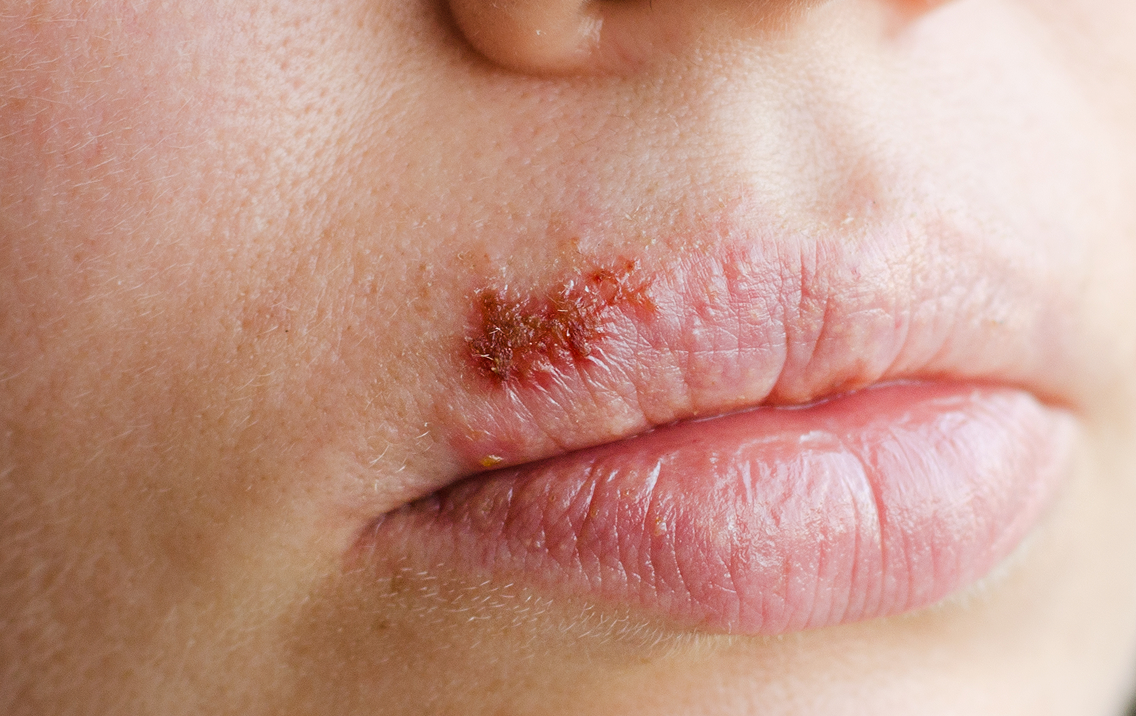 Close-up of a person's mouth with a small wound or lesion on the lip.