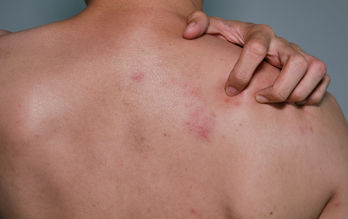 Person with a red mark on their shoulder against a neutral background